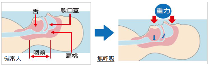 がん活性消滅療法（CEAT）とは